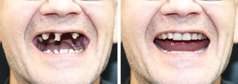 teeth2